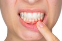 Estudo da UFMA cria método mais rápido e barato para diagnosticar infecção que causa perda de dentes